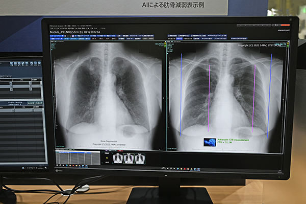 AIによる「肋骨減弱機能」（左）と「心胸郭比自動計測機能」　（右）（いずれもW.I.P.）