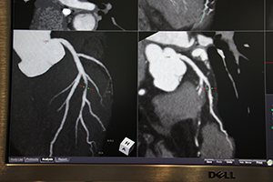 CT冠動脈比較解析：サブトラクション後