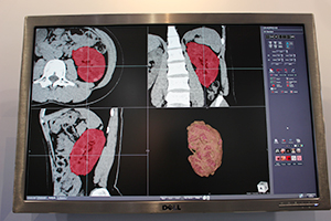 腎臓抽出：体積の計測結果が，VR画像の右下に数値で示される。