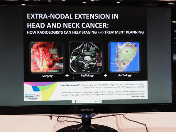 Extra-Nodal Extension in Head and Neck Cancer: How Radiologists Can Help Staging and Treatment Planning 檜山貴志氏（国立がん研究センター東病院）ほか