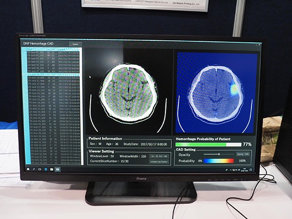大阪大学と共同研究する脳出血検出技術