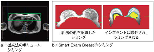 }2@Smart Exam Breast̐ÎV~O