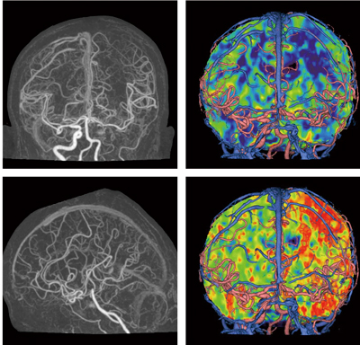 }3@perfusion CT摜iAIDR 3D gpǗj