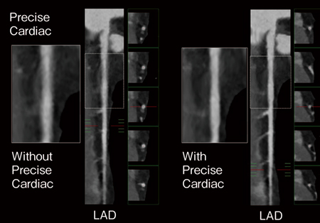 AIを活用したPrecise Cardiacの使用例