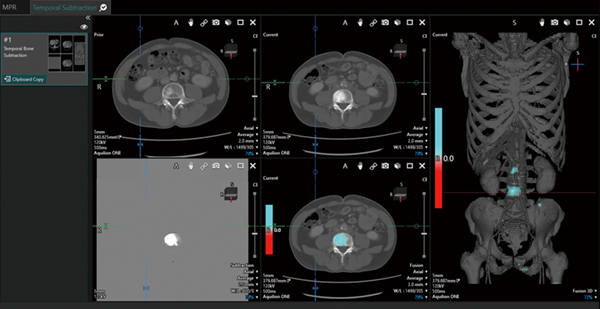 図1　Temporal Subtraction For Bone 膀胱がん術後、リンパ節転移に対する化学療法中の症例。フォローのCTで、第2・4腰椎椎体、左腸骨に硬化性変化の増強を認め、骨転移が疑われた。その後、腰痛の出現があり、疼痛に対する緩和照射が行われた。Findings Workflow画面では、過去（左上）、今回（中央上）、サブトラクション（左下）、フュージョン（中央下）、3Dフュージョン（右）が1画面で表示される。
