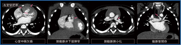 図2　ファロー四徴症疑い症例の心電図同期CT画像（1歳，女児）