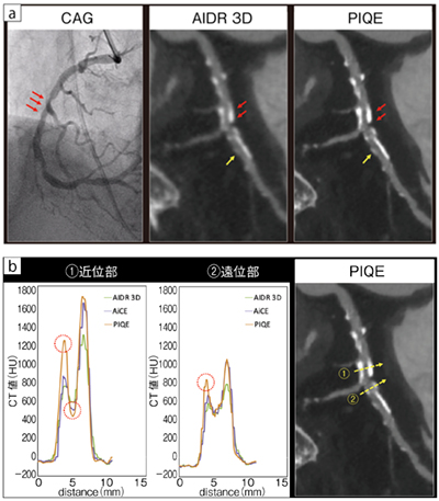 図2　高度石灰化症例の冠動脈CT画像とプロファイルカーブ a：AIDR 3DとPIQEの比較　b：プロファイルカーブ