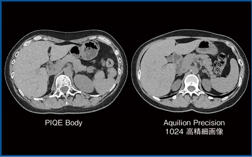 図1　PIQE BodyとAquilion Precisionの臨床画像（別症例）の比較