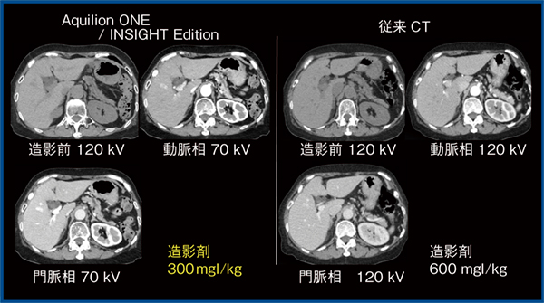 図3　正常肝（同一症例）におけるAquilion ONE / INSIGHT Editionと従来CTの画像比較