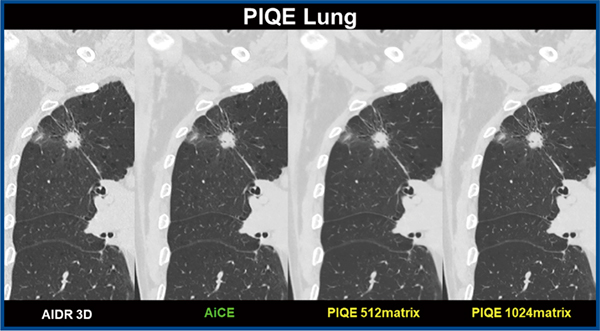 図4　右上葉肺がん症例におけるPIQEを用いたSuper Resolution DLR 右上葉肺がん症例をAIDR 3DやAiCEにて再構成したCTデータと比較して，PIQEを用いて512マトリックスや1024マトリックスに再構成したCTデータでは著明な画質改善を示すとともに，1024マトリックスでは結節周囲の微細構造の描出能改善が認められる。