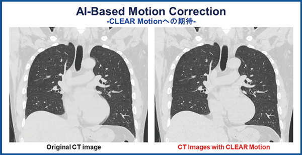 図5　AI-Based Motion CorrectionであるCLEAR Motionによる胸部CTにおける画質改善 CLEAR Motionを用いてCT画像を再構成することにより，大動脈弓および左室による心拍に伴うモーションアーチファクトが改善されている。