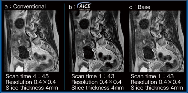 図1　AiCEを適用したCompressed SPEEDERと従来法の比較（子宮筋腫：1.5T）