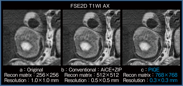 図2　T1強調画像におけるPIQEと従来法の比較（左卵巣奇形腫：1.5T）