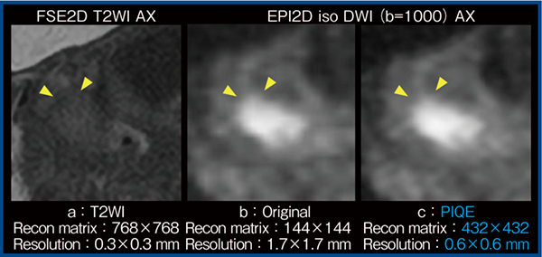 図3　拡散強調画像におけるPIQEの適用例（子宮体がんⅠA期：3T）