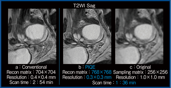 図4　PIQEを適用した短時間撮像と従来法の比較（機能性卵巣囊胞：1.5T）
