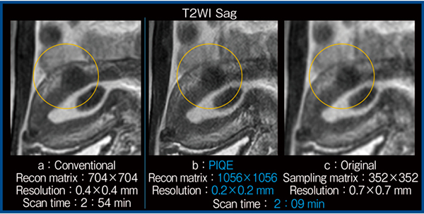 図5　T2強調画像におけるPIQEと従来法の比較（子宮筋腫：1.5T）
