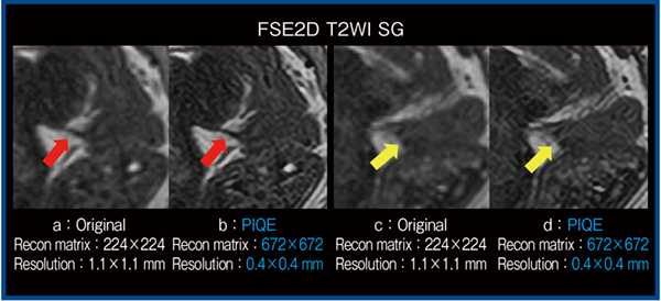 図6　T2強調画像におけるPIQEの適用例（子宮内膜症：3T）