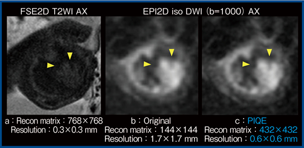 図7　拡散強調画像におけるPIQEの適用例（子宮体がんⅣ期：3T）