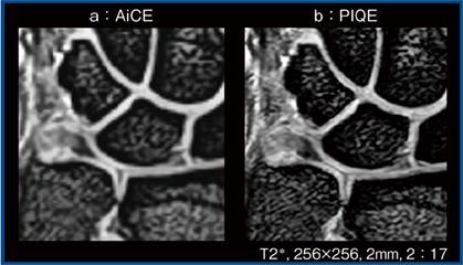 図2　骨間靭帯断裂および関節軟骨損傷の症例におけるAiCEとPIQEの画像比較