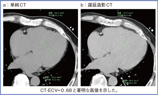 図4　症例3：冠動脈疾患の精査目的で冠動脈CTを施行した症例