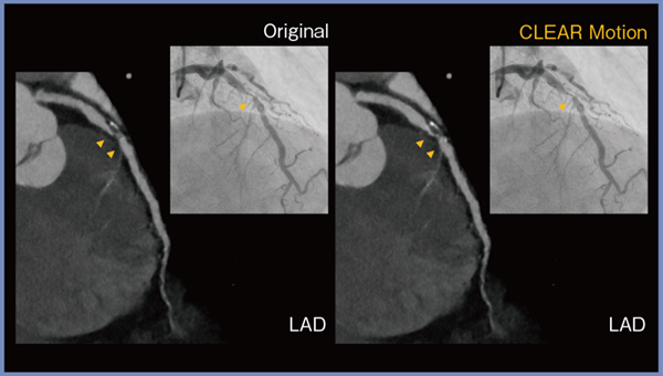 図5　CLEAR Motionによる冠動脈の描出の改善（長軸像）