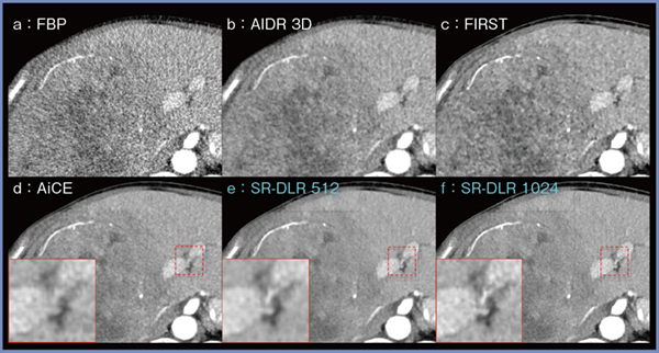 図1　画像再構成法による画質の違い（肝腫瘍，0.5mmスライス）
