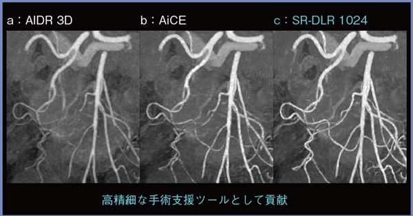 図3　症例1：膵周囲の動脈のMIP画像