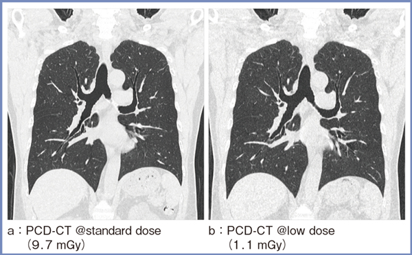 図3　PCD-CTによる肺の低線量CT