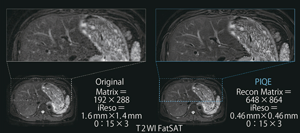 図2　脂肪抑制T2強調画像にPIQEを適用した例