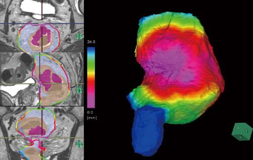 図2　腫瘍と直腸間膜の距離に応じたカラーマップ表示