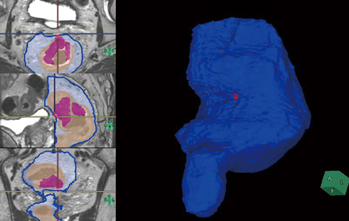 図3　腫瘍と直腸間膜までの距離が1mm以下の領域を強調表示