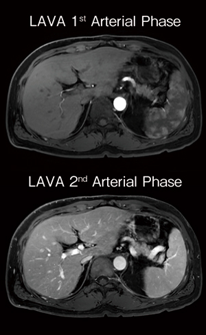 図1　Dual Arterial Phase Dynamic LAVA with AIR Recon DL 3D（9s/phase） 短い撮像時間でも画質を損なわずに，多相動脈相を実現。