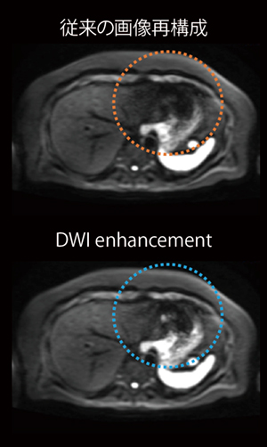 図2　上腹部の拡散強調画像 DWI enhancementにより肝左葉のシェーディングが軽減されている。