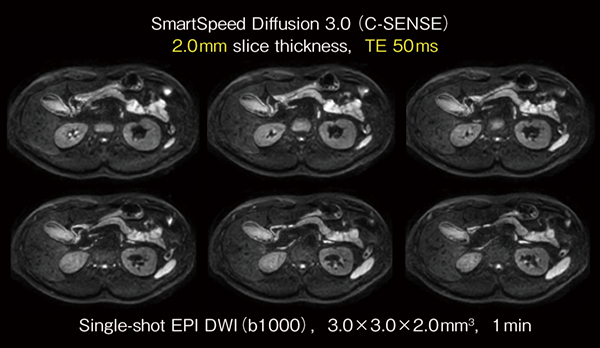 図2　SmartSpeed Diffusionの臨床応用例（肝臓，膵臓） 研究機「MR 7700」で撮像されたC-SENSE併用の拡散強調画像。2mmスライス厚でありながら高いSNRが保持されている。 〔画像ご提供：浜松医科大学医学部附属病院様（MR7700）〕