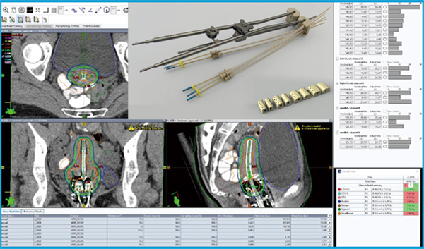 図3　IC/IS用のタンデム&オボイドを用いた腔内照射