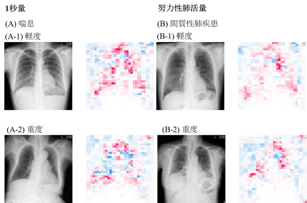 図　喘息や間質性肺疾患患者の胸部X線写真とその特徴マップ。 赤が正常な領域，青が異常な領域を示す。