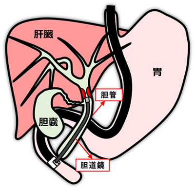 図1：経口胆道鏡のイメージ図　胆道鏡を使用することで胆管内の病変を直接視認することが可能となる。